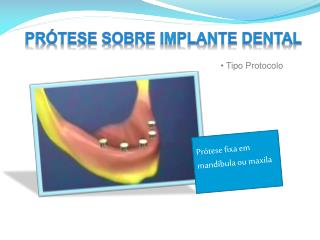 Prótese sobre Implante Dental