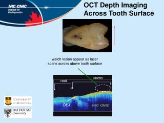 OCT Depth Imaging Across Tooth Surface