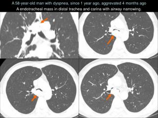 A 58-year-old man with dyspnea, since 1 year ago, aggrevated 4 months ago