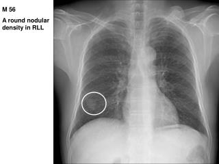 M 56 A round nodular density in RLL