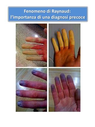 Fenomeno di Raynaud : l’importanza di una diagnosi precoce