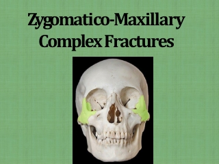 Z y g om a ti c o -M a xilla r y C omplex Fracture s