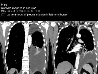 Pleural VAT’s biopsy: Epithelioid Mesothelioma