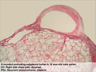 Thick pleural fibrosis due to repeated air leakage and inflammaion