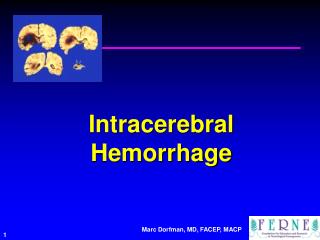 Intracerebral Hemorrhage