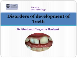 Disorders of development of Teeth