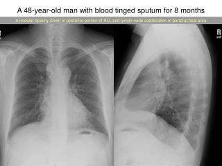 A 48-year-old man with blood tinged sputum for 8 months