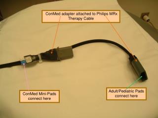 ConMed adapter attached to Philips MRx Therapy Cable