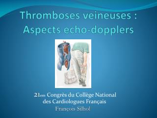 Thromboses veineuses : Aspects echo - dopplers