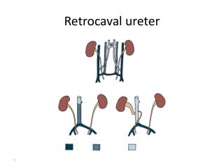 Retrocaval ureter