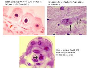 Cytomegalovirus infection: Owl’s eye nuclear inclusion bodies (basophilic)