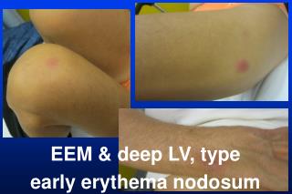 EEM &amp; deep LV, type early erythema nodosum