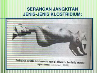 SERANGAN JANGKITAN JENIS-JENIS KLOSTRIDIUM: