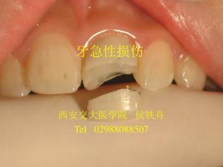 牙急性损伤