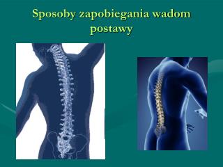 Sposoby zapobiegania wadom postawy