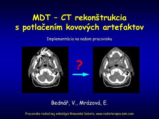 MDT – CT rekon štrukcia s potlačením kovových artefaktov