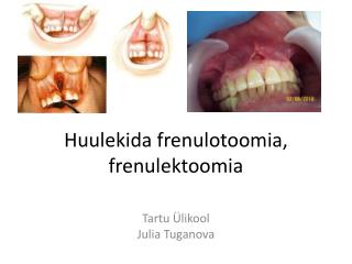 Huulekida frenulotoomia , frenulektoomia