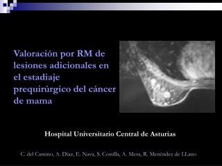 Valoración por RM de lesiones adicionales en el estadiaje prequirúrgico del cáncer de mama
