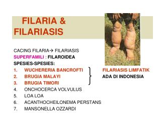 FILARIA &amp; FILARIASIS