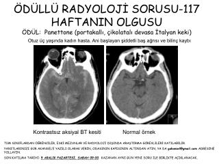 Otuz üç yaşında kadın hasta. Ani başlayan şiddetli baş ağrısı ve bilinç kaybı