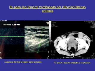 By-pass ileo-femoral trombosado por infección/abceso prótesis