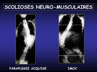 SCOLIOSES NEURO-MUSCULAIRES