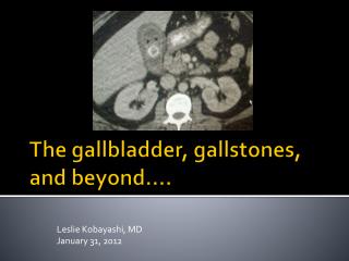 The gallbladder, gallstones, and beyond….