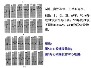 A 图：窦性心律，正常心电图； B 图： Ⅰ ， Ⅱ ， Ⅲ ， aVF ， V2~6 导联 ST 段水平形下降， V5 导联 ST 段下降达 0.25mV ， aVR 导联 ST 段抬高。