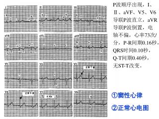 ① 窦性心律 ②正常心电图