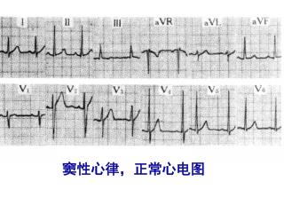 窦性心律，正常心电图