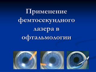 Применение фемтосекундного лазера в офтальмологии