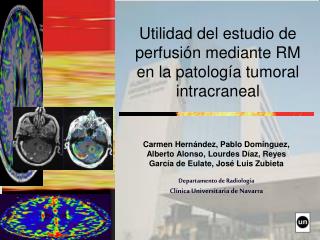 Utilidad del estudio de perfusión mediante RM en la patología tumoral intracraneal