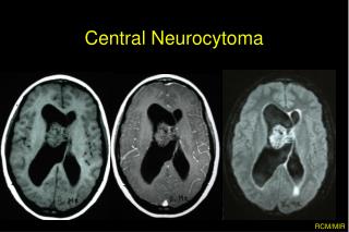 Central Neurocytoma