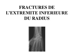 FRACTURES DE L’EXTREMITE INFERIEURE DU RADIUS