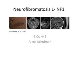 Neurofibromatosis 1- NF1