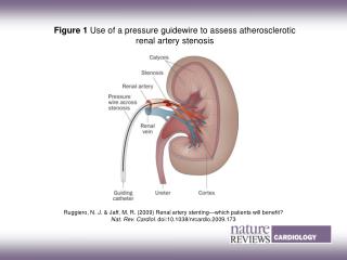 Figure 1 Use of a pressure guidewire to assess atherosclerotic renal artery stenosis