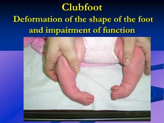 Clubfoot Deformation of the shape of the foot and impairment of function