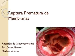 Ruptura Prematura de Membranas