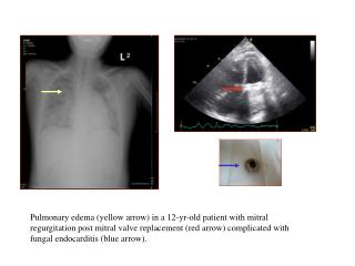 On short-axis view, left and right coronary artery aneurysms were