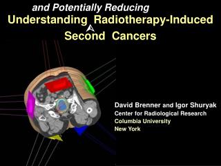 Understanding Radiotherapy-Induced Second Cancers