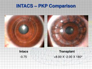 INTACS – PKP Comparison