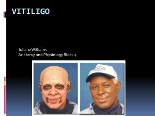 Vitiligo