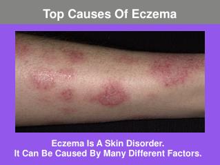 Top Causes Of Eczema