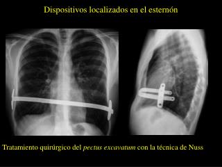 Dispositivos localizados en el esternón