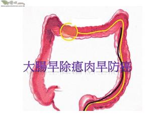 大腸早除瘜肉早防癌