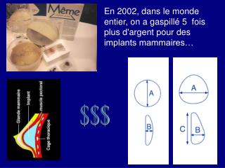 En 2002, dans le monde entier, on a gaspillé 5  fois plus d'argent pour des implants mammaires…