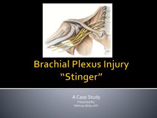 Brachial Plexus Injury “Stinger”