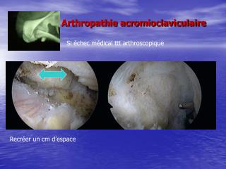 Arthropathie acromioclaviculaire