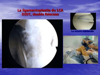 La ligamentoplastie du LCA DIDT, double faisceau