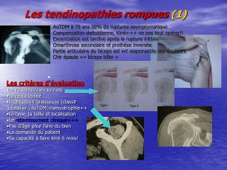 Les tendinopathies rompues (1)
